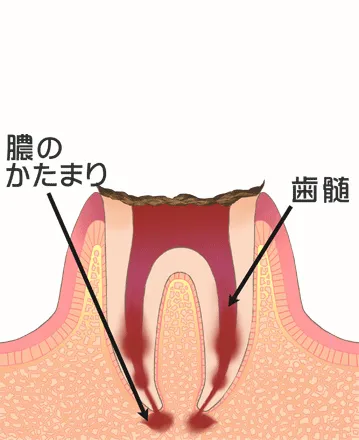 末期のむし歯